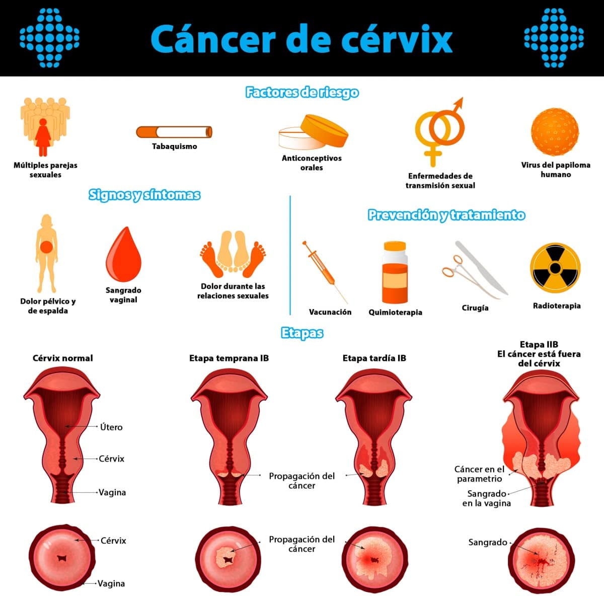 Cáncer de Cérvix