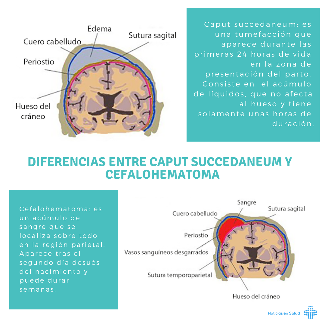 Diferencias entre Caput succedaneum y Cefalohematoma [Infografía]