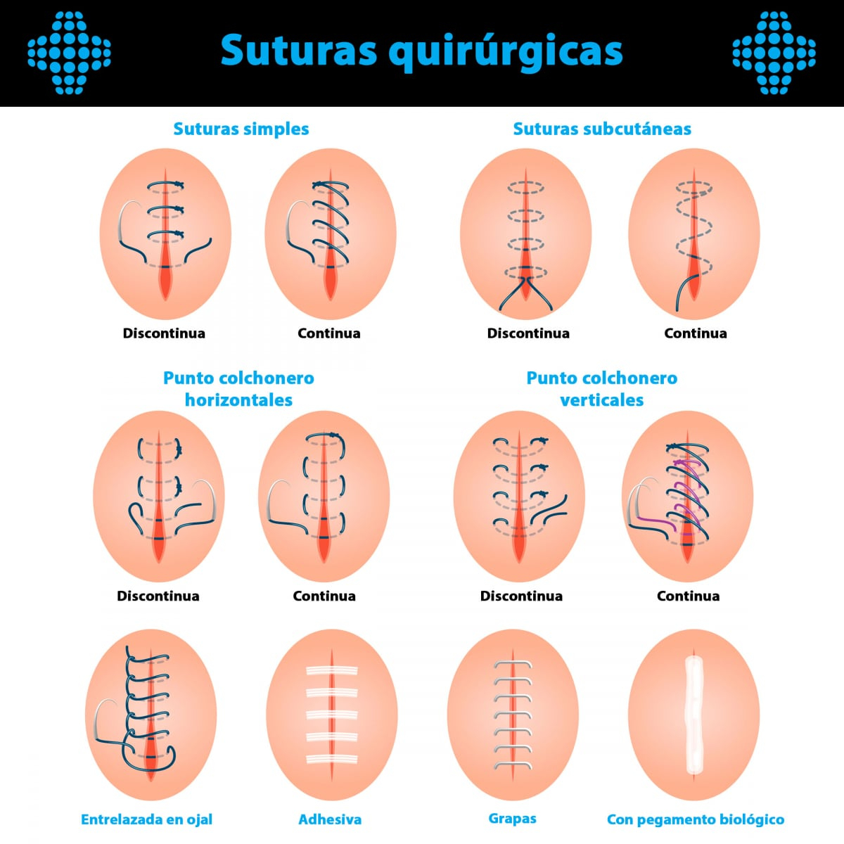 Tipos de suturas