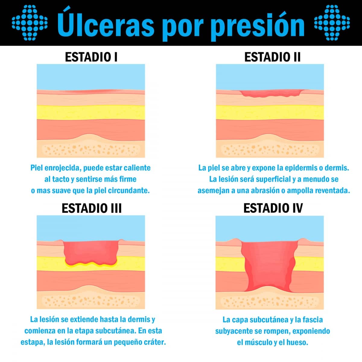 Estadios de las úlceras por presión