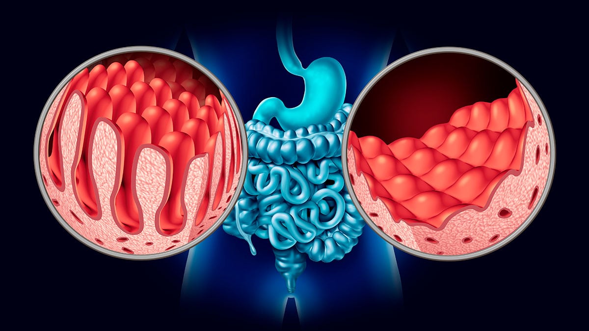 Enlace bacterias en enfermedad celiaca