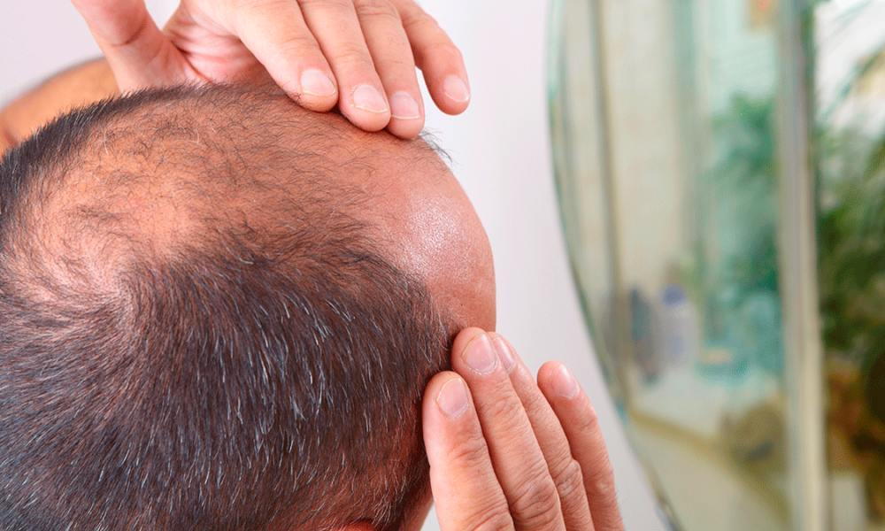 Cómo poner fin a la alopecia? capilares frenar la calvicie - Noticias en