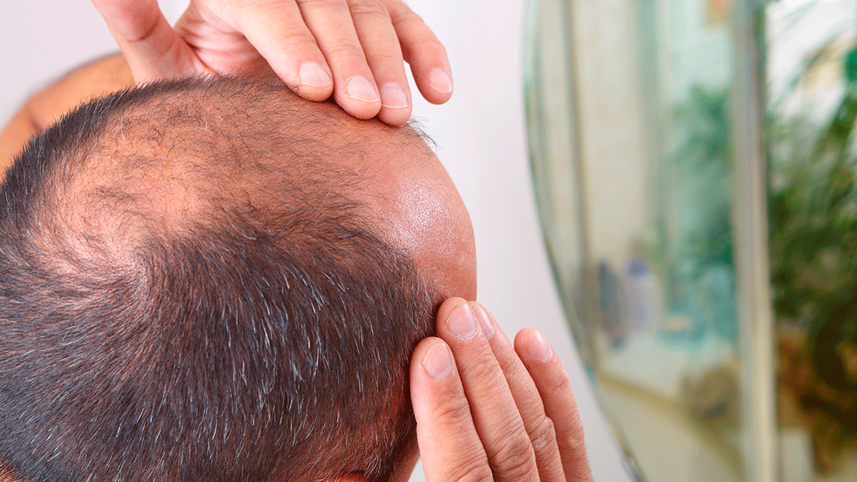 Cómo poner fin a la alopecia? capilares frenar la calvicie - Noticias en