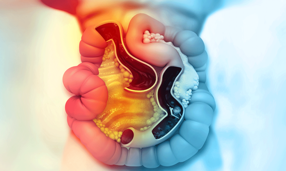 Experts celebrate the arrival of a new treatment for colorectal cancer BRAF +, associated with a worse prognosis and greater risk of progression thumbnail