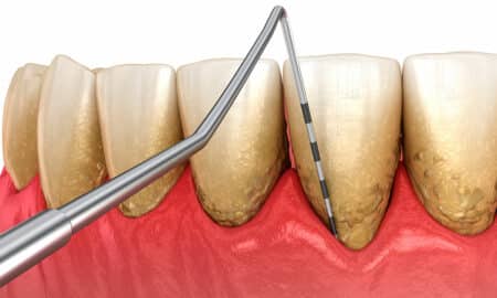 periodontitis