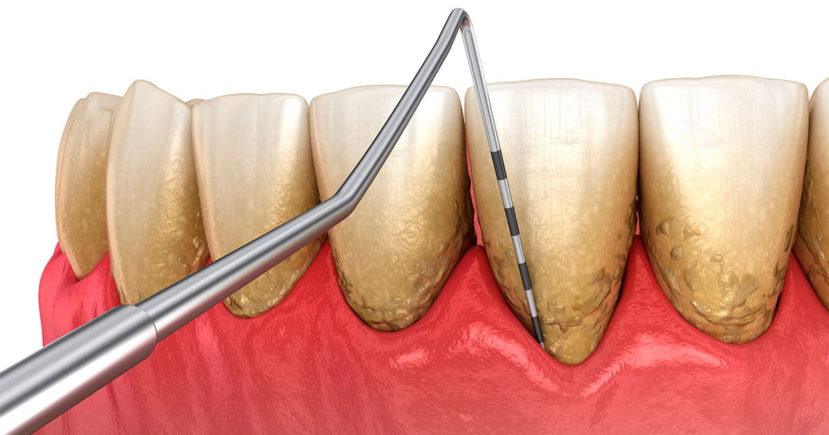 periodontitis