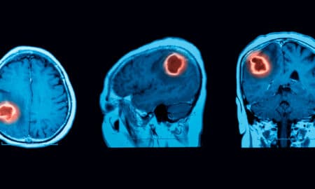 tumor cerebral