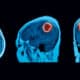 tumor cerebral