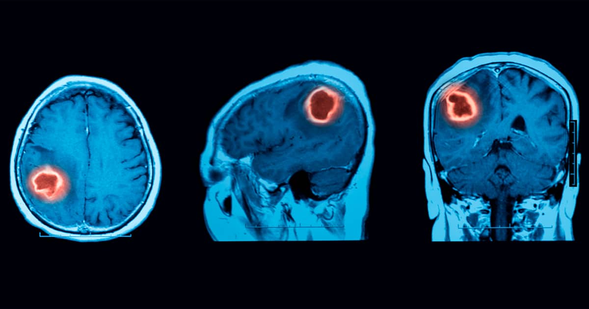 tumor cerebral