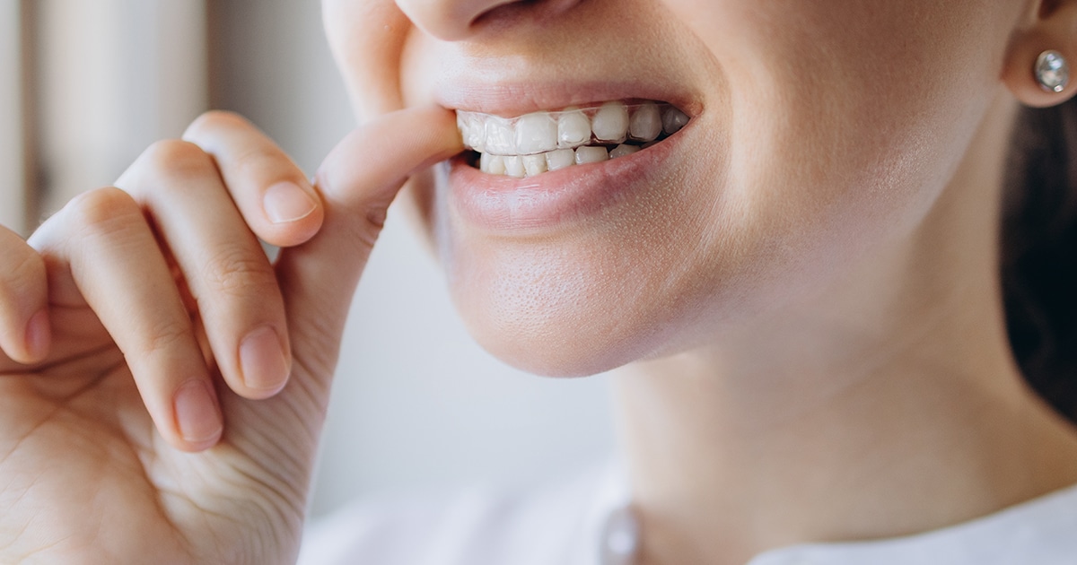 Ortodoncia invisible Dentin